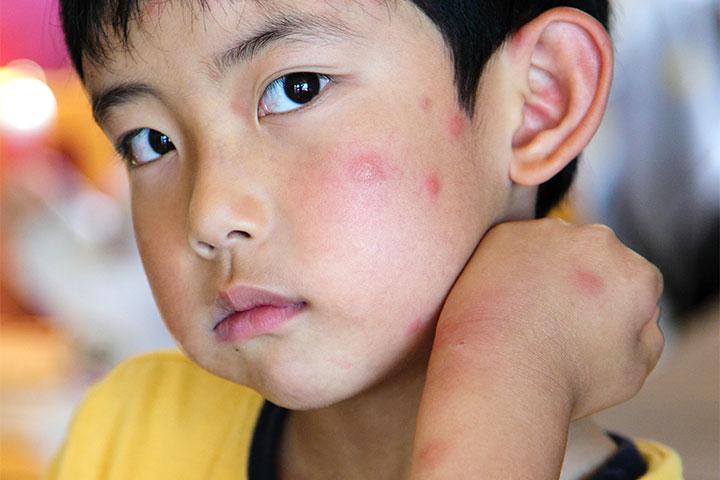 Allergies In Children3