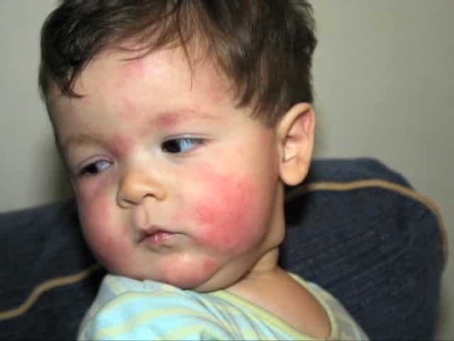 Allergies In Children4