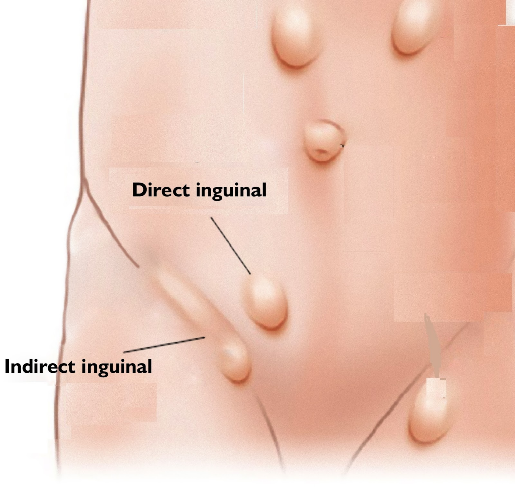 Inguinal Hernia - Symptoms, Causes And It's Prevention What Is An Inguinal Hernia1